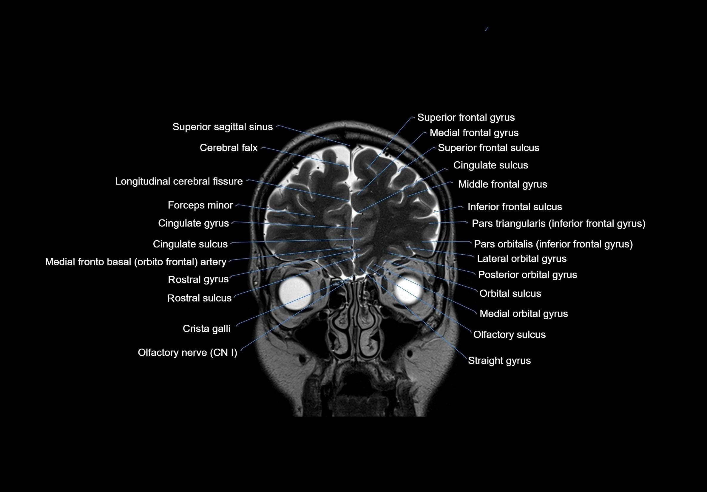 MRI Brain coronal cross sectional labelled anatomy 3T image  -img-00001-00015.webp